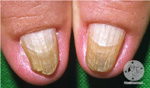 Lichen Planus