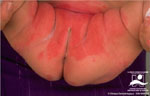 Windeldermatitis