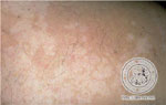 Pityriasis versicolor