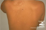Pityriasis versicolor